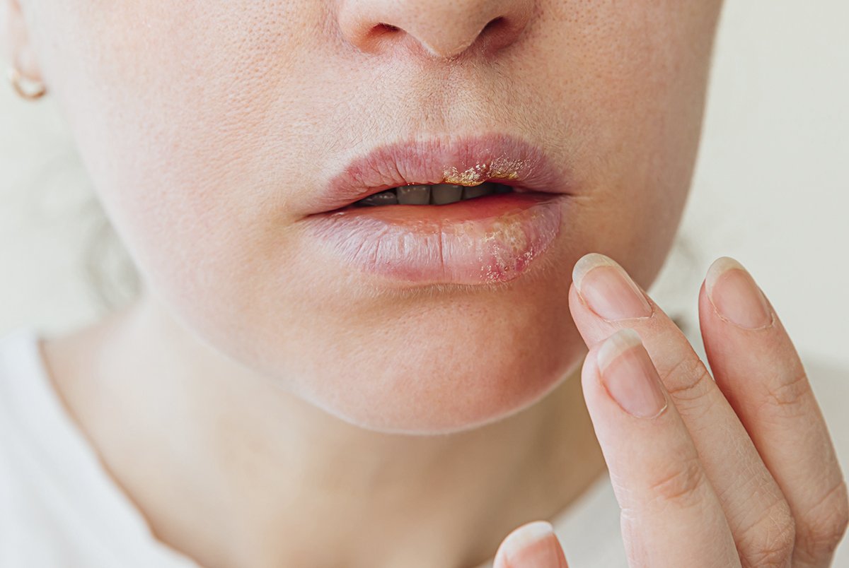 Kit de cuidados orais supera saliva artificial no cuidado de pacientes internados em UTI 